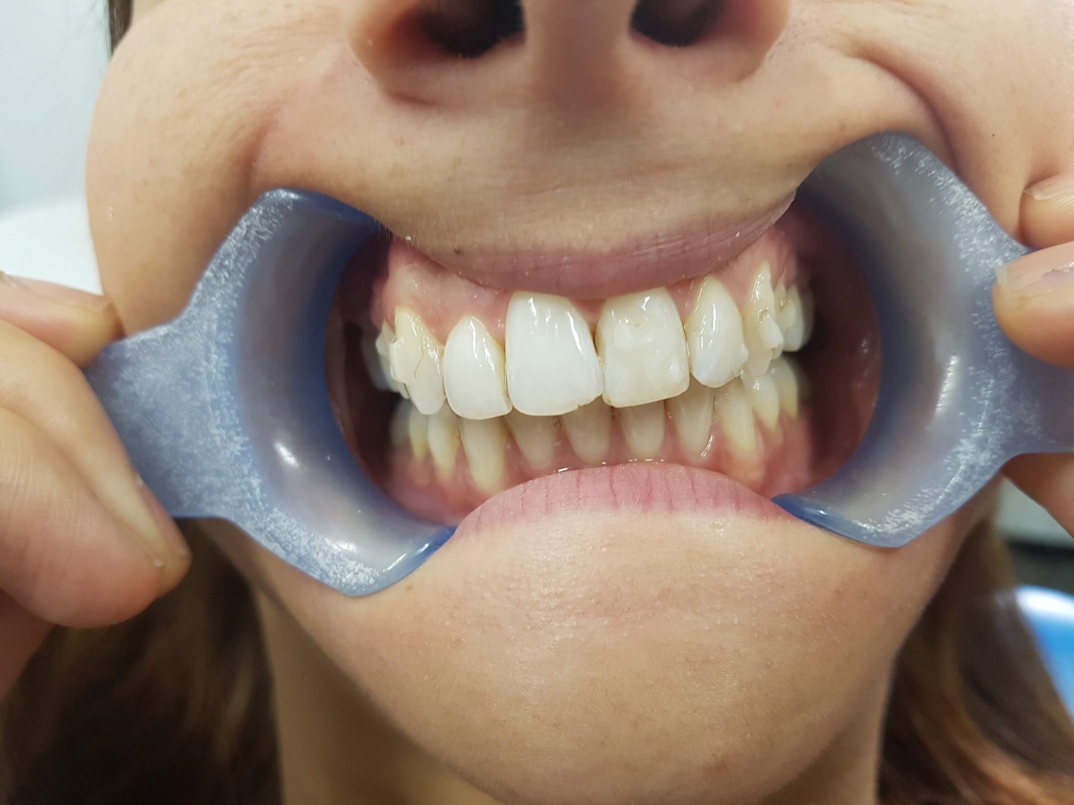 Teeth straightening Bristol after case 2 closed gaps