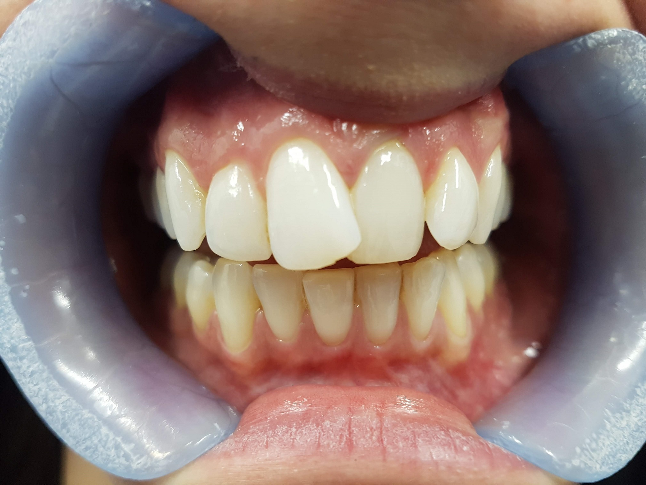 Teeth straightening Bristol before case 2 spacing