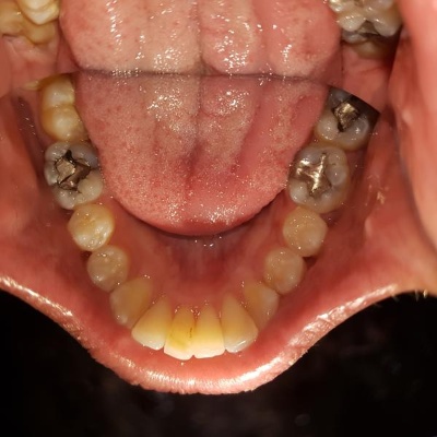 Teeth straightening Bristol after case 3 improved bite