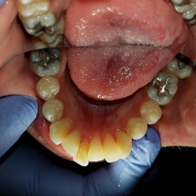 Teeth straightening Bristol before case 3 crossbite
