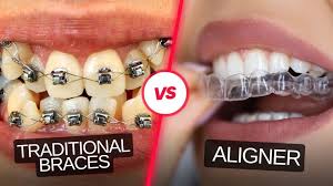 Close up of clear aligner on teeth for teeth straightening Bristol